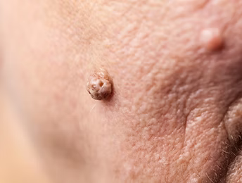 Benign Skin Conditions-2