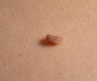 Benign Skin Conditions-3