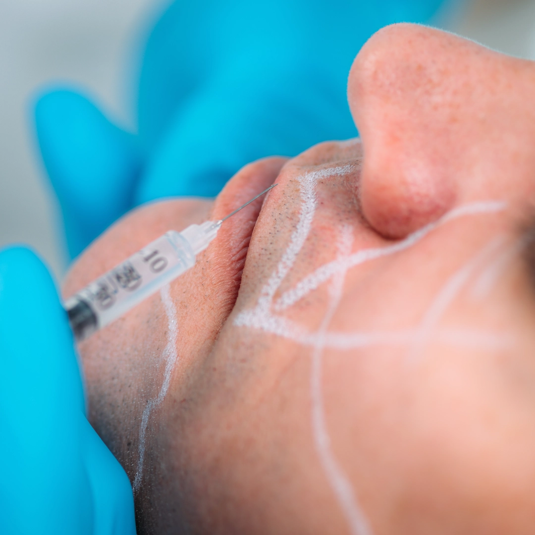 Dermal fillers