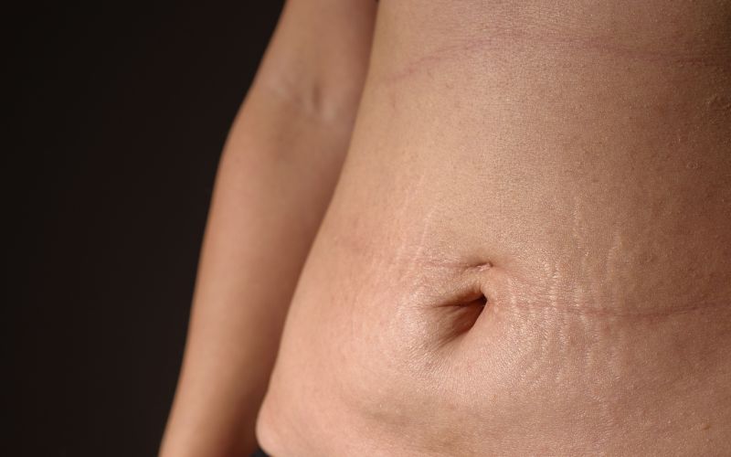 Abdomen: Smooth post-pregnancy laxity or navel skin