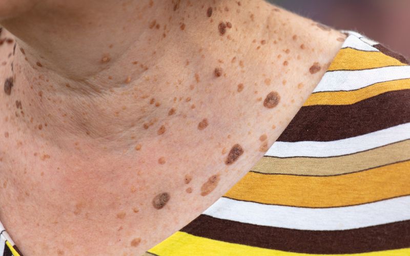 BENIGN SKIN CONDITIONS