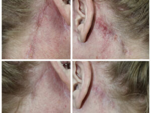 Understanding Hypertrophic Scars- Causes and Treatments