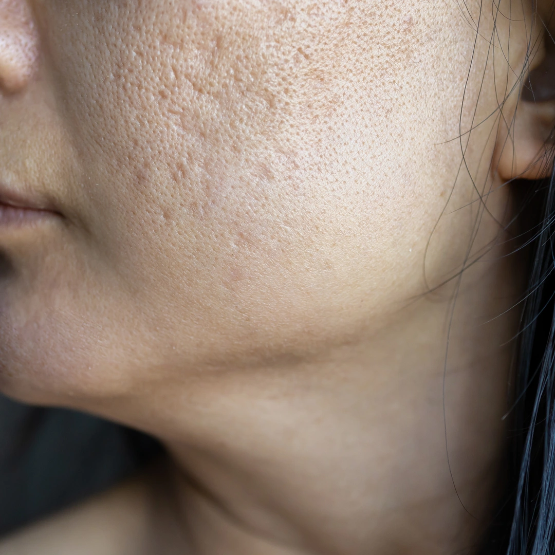 acne scar treatment