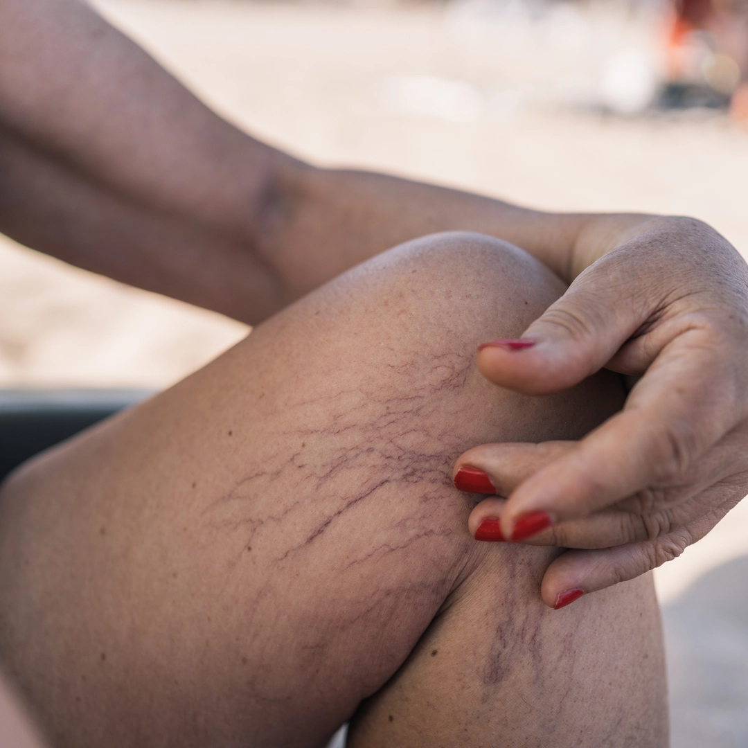 Thread vein removal