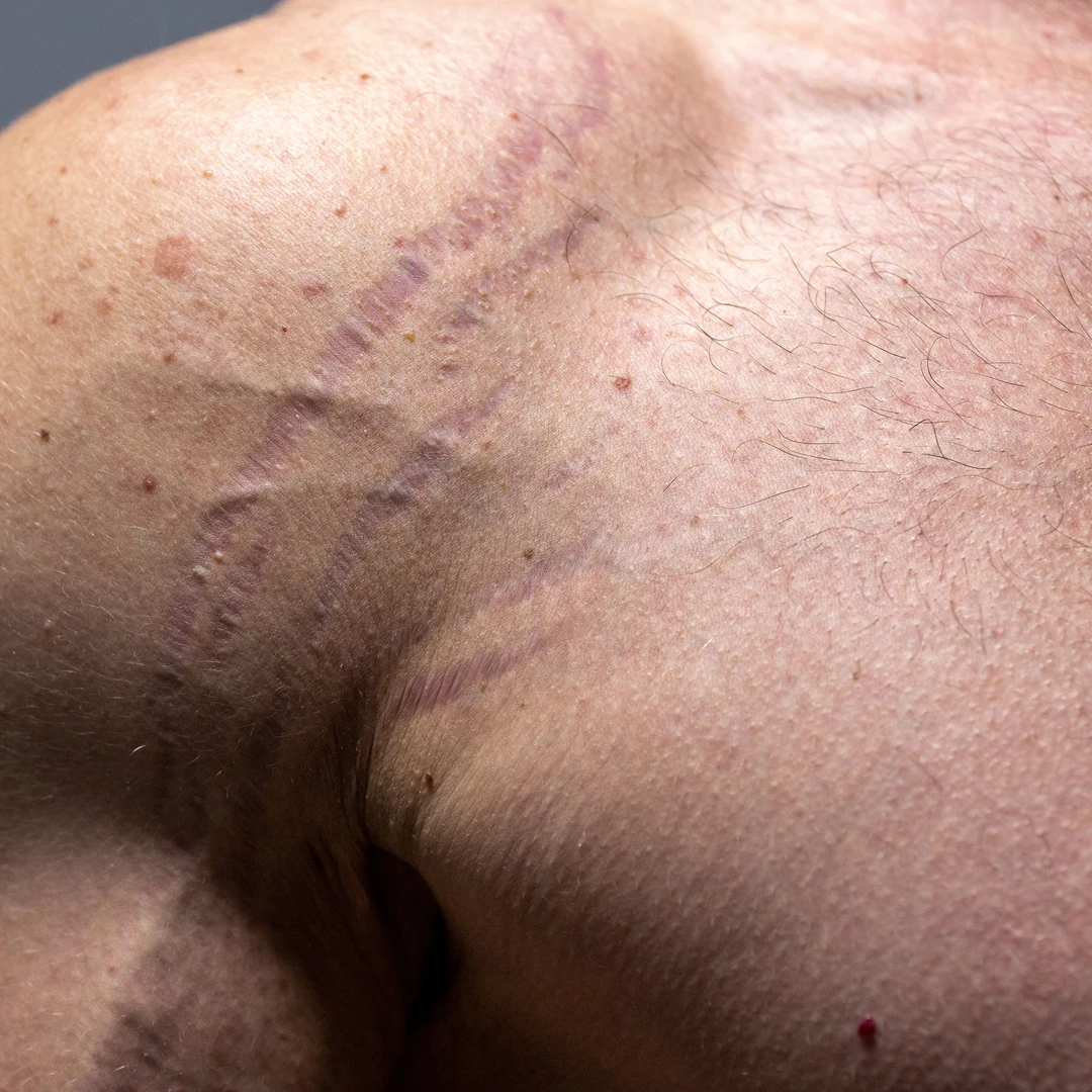 Stretch Mark
