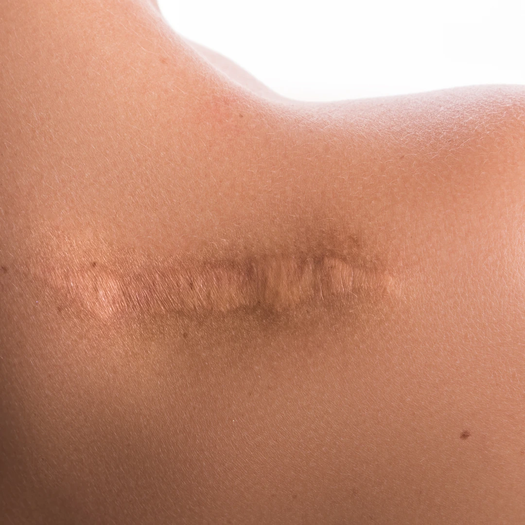 athrophic scar