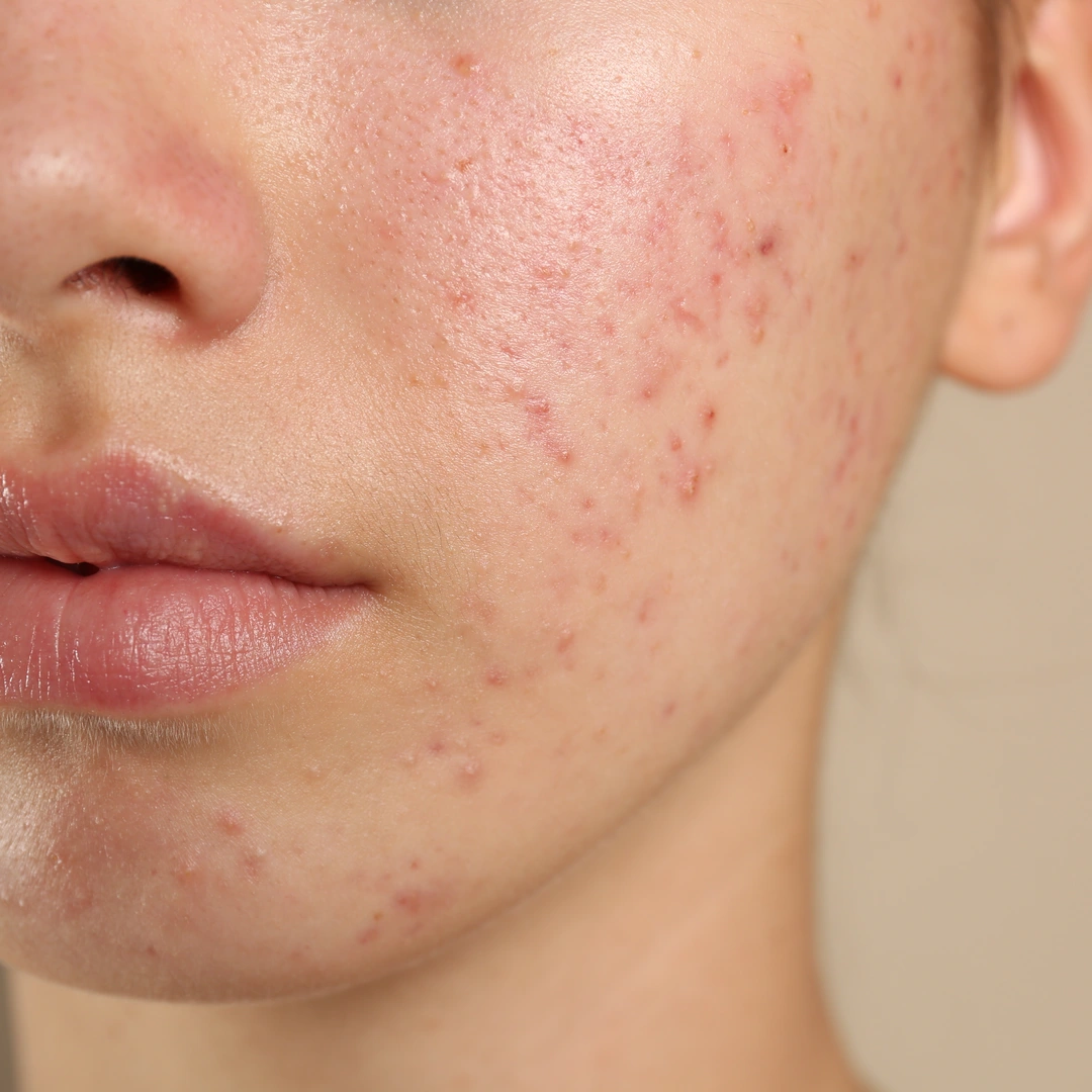 Acne prone skin flareup