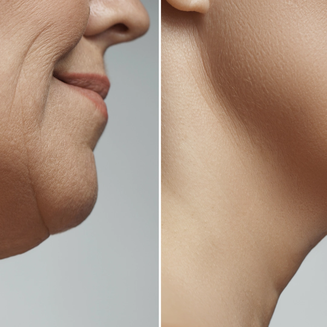 full face transformation