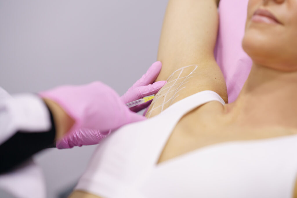 Doctor makes intramuscular injections of botulinum toxin in the underarm area against hyperhidrosis.