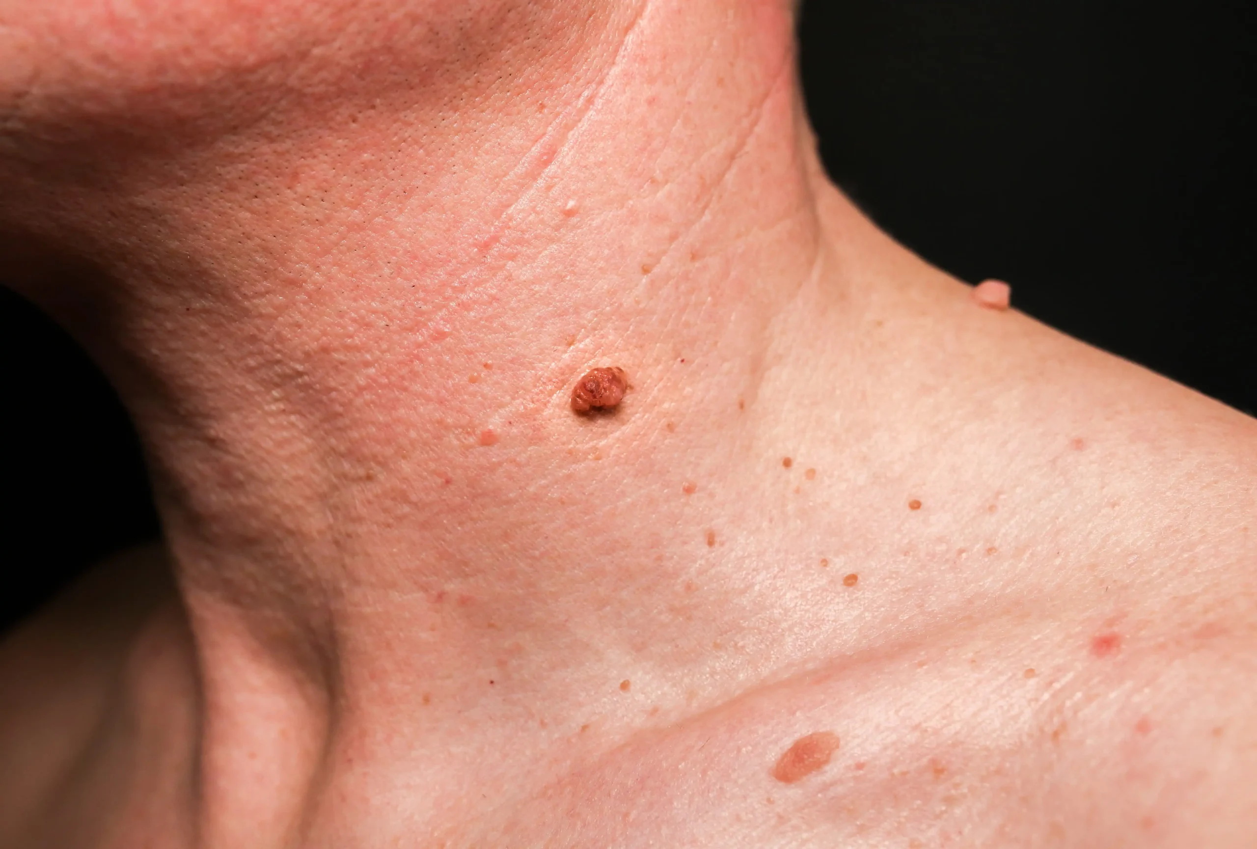 benign skin conditions