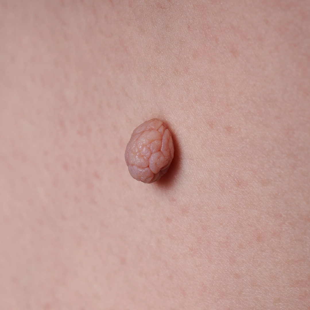 Skin tags