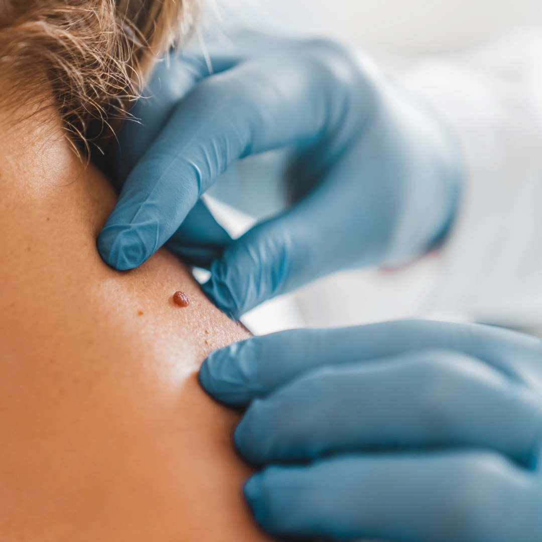 Skin tags