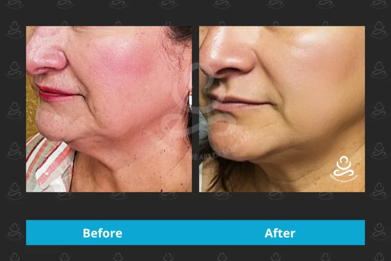 Endolift Face & Neck