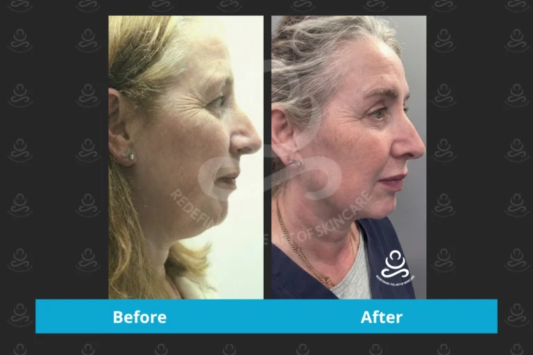 Endolift Face & Neck