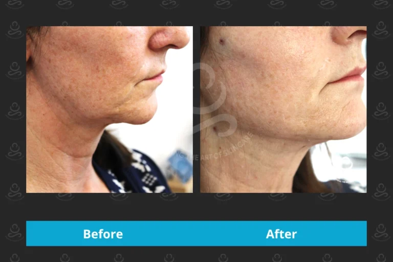 Endolift Face & Neck