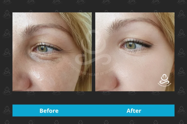 Laser Rejuvenation