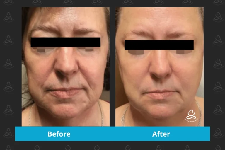 Laser Rejuvenation