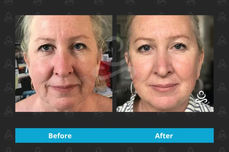 Laser Rejuvenation