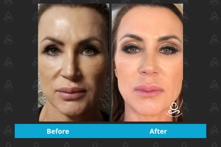 Laser Rejuvenation