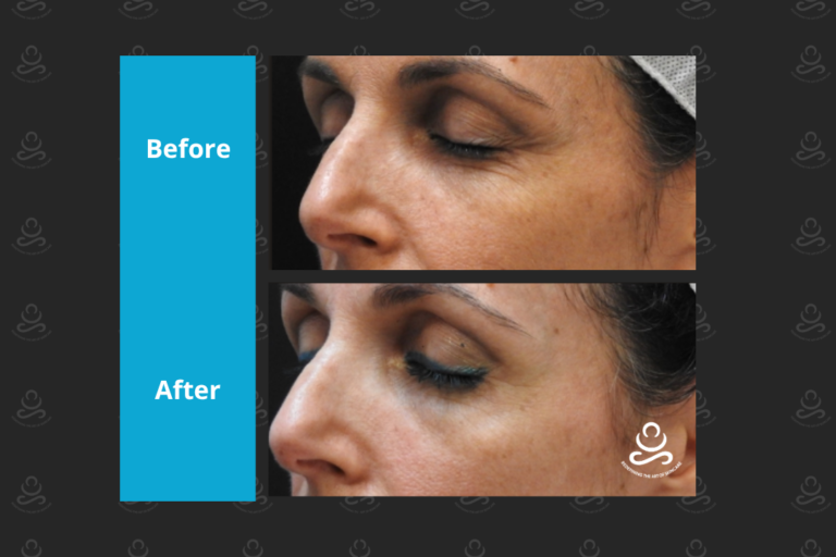 Laser Rejuvenation