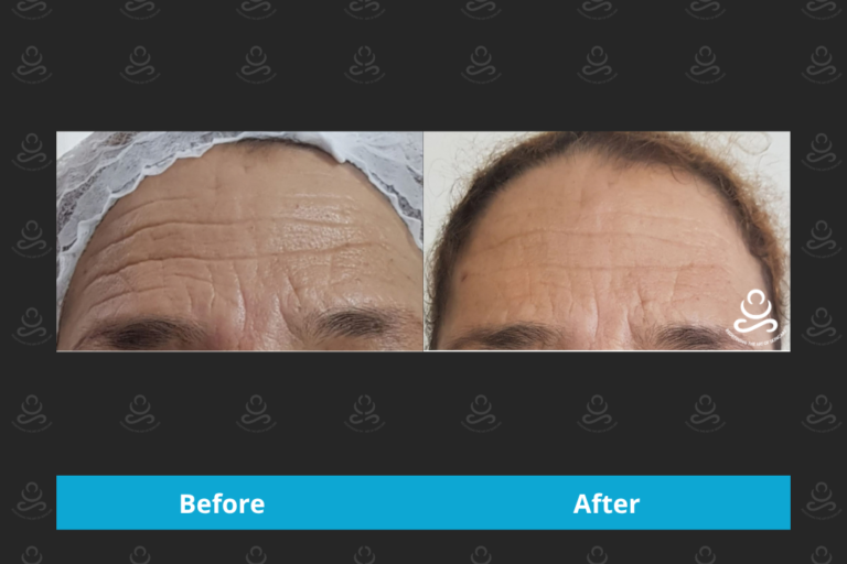 Laser Rejuvenation