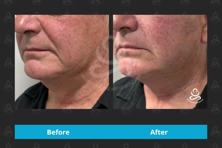 Endolift Face & Neck