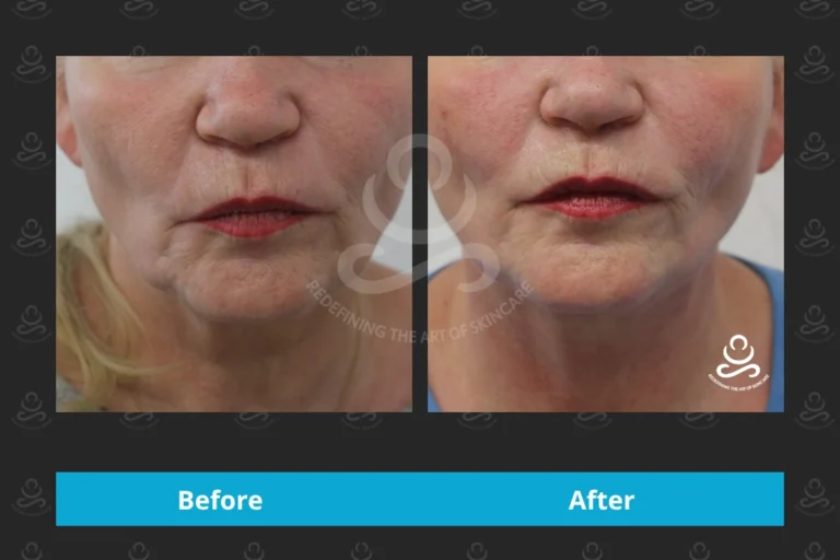 Endolift Face & Neck
