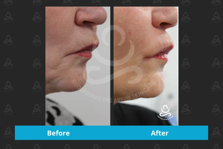 Endolift Face & Neck