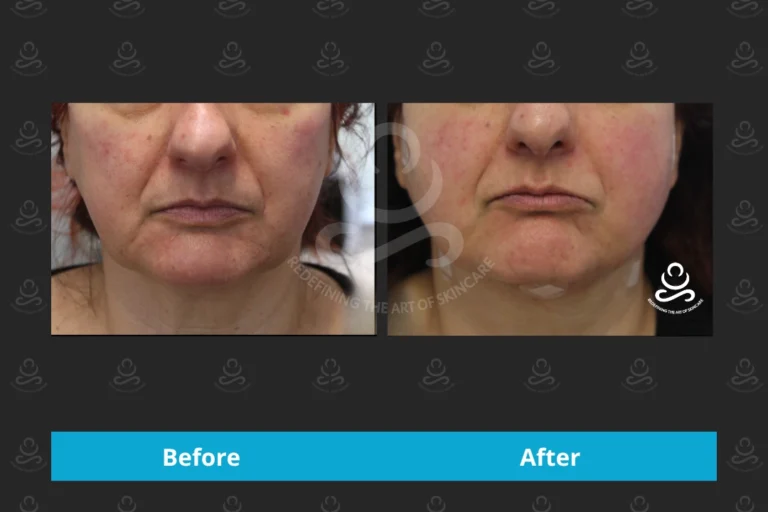 Endolift Face & Neck