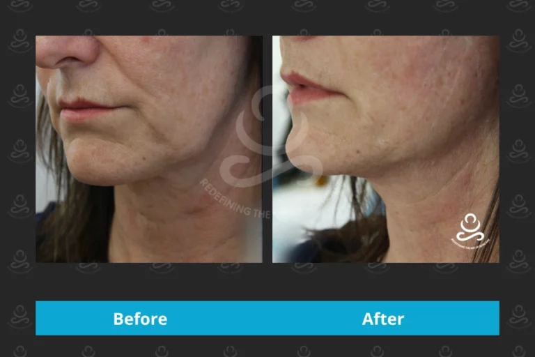 Endolift Face & Neck
