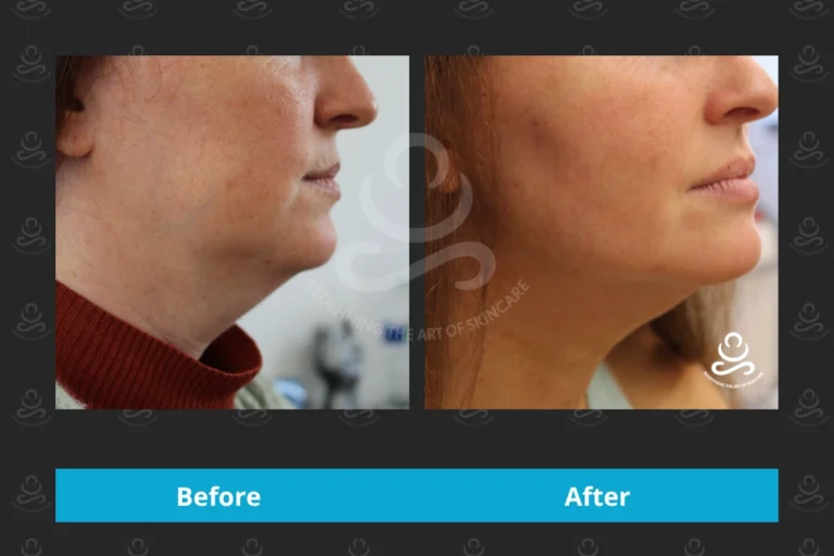 Endolift Face & Neck