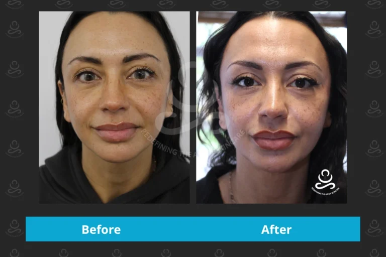 Endolift Face & Neck