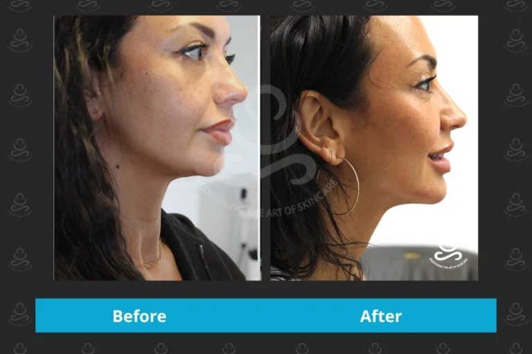 Endolift Face & Neck
