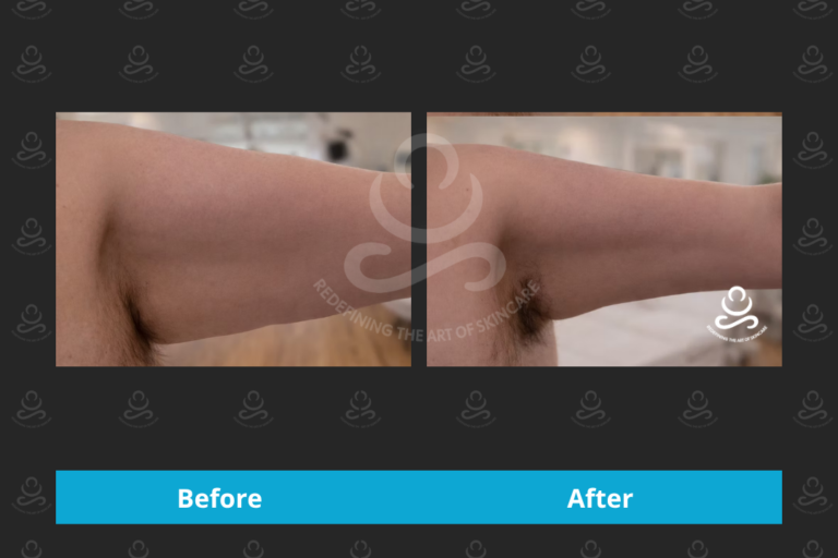 Endolift Inner Arms