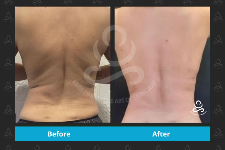 Endolift Back