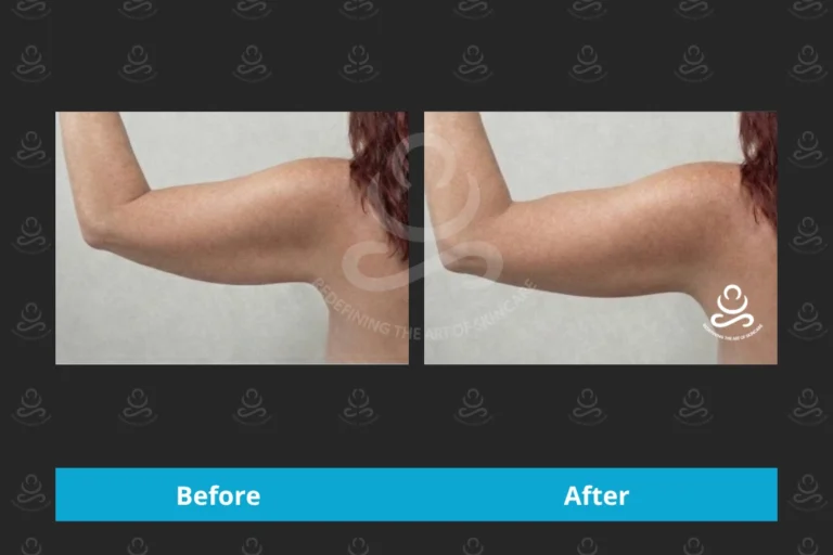 Endolift Inner Arms
