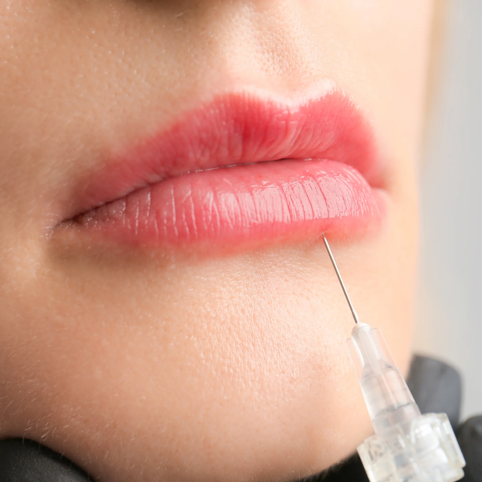dermal fillers