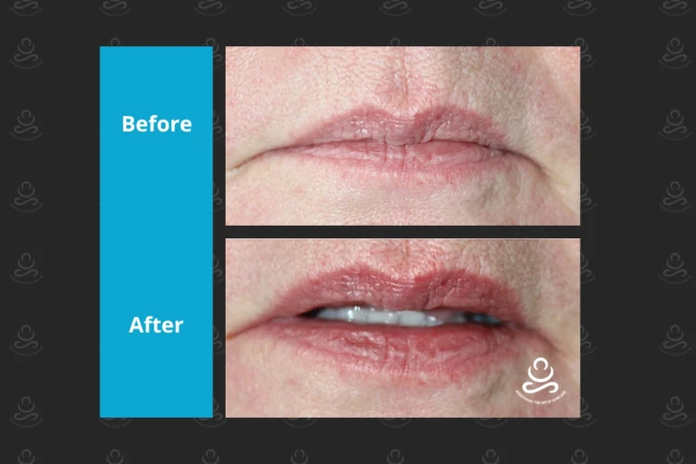 Laser Rejuvenation