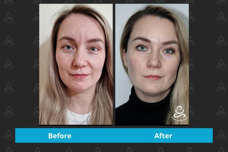 Laser Rejuvenation