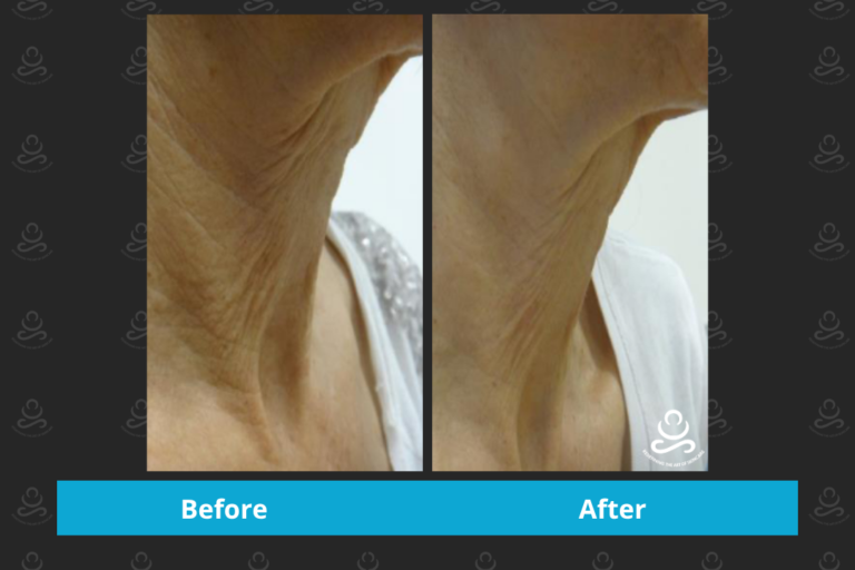 Laser Rejuvenation