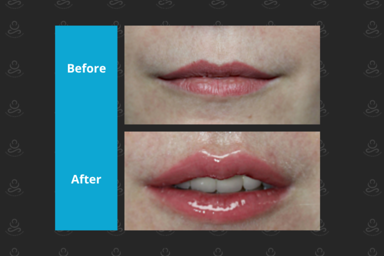 Laser Rejuvenation
